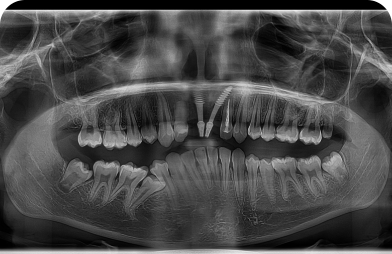 After image
